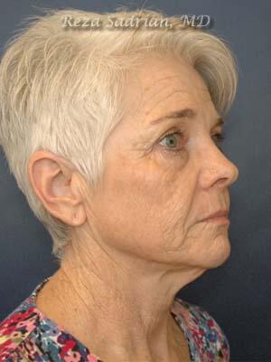 Face & Neck Lift Before & After Image