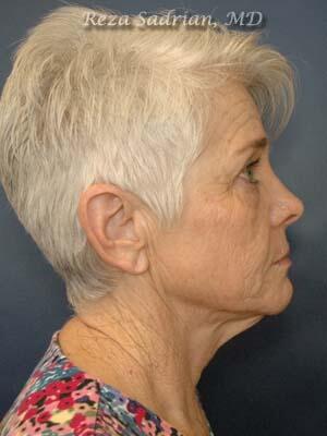 Face & Neck Lift Before & After Image