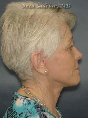 Face & Neck Lift Before & After Image