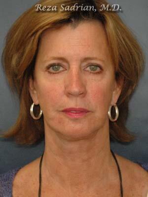 Face & Neck Lift Before & After Image