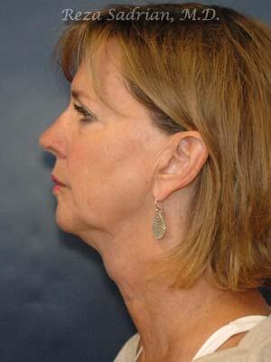 Face & Neck Lift Before & After Image