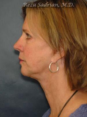 Face & Neck Lift Before & After Image