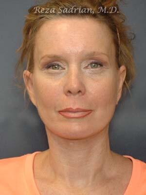 Face & Neck Lift Before & After Image