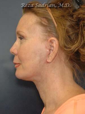 Face & Neck Lift Before & After Image