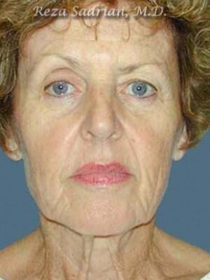 Face & Neck Lift Before & After Image