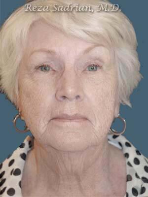 Face & Neck Lift Before & After Image