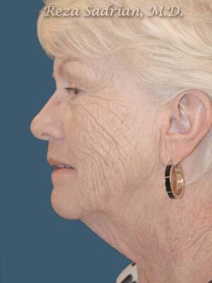 Face & Neck Lift Before & After Image