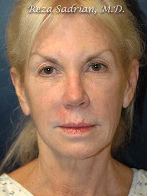 Face & Neck Lift Before & After Image