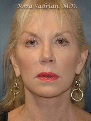 Face & Neck Lift Before & After Image