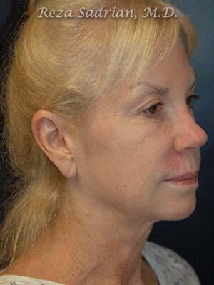 Face & Neck Lift Before & After Image