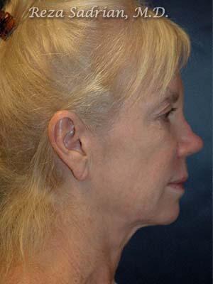 Face & Neck Lift Before & After Image