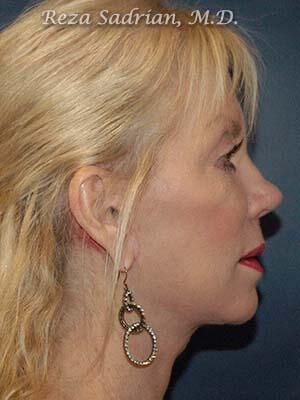 Face & Neck Lift Before & After Image