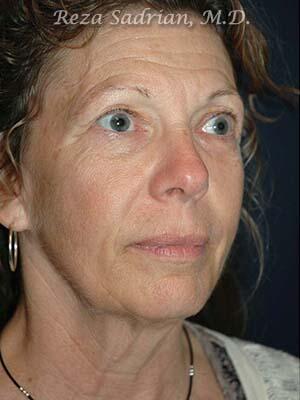 Face & Neck Lift Before & After Image