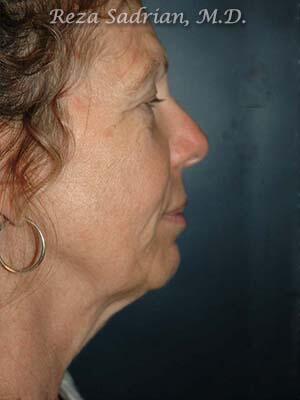 Face & Neck Lift Before & After Image