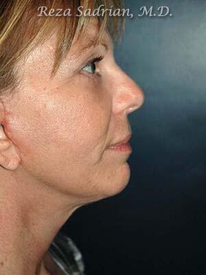 Face & Neck Lift Before & After Image