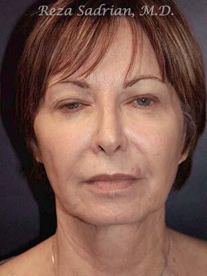 Face & Neck Lift Before & After Image