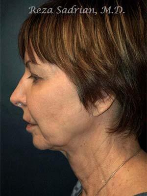 Face & Neck Lift Before & After Image