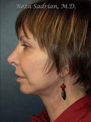 Face & Neck Lift Before & After Image