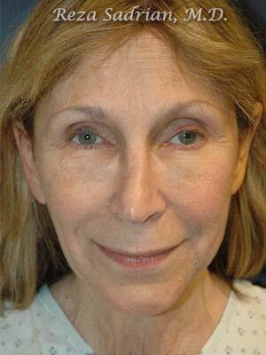 Face & Neck Lift Before & After Image