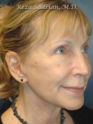 Face & Neck Lift Before & After Image