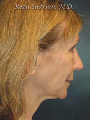 Face & Neck Lift Before & After Image