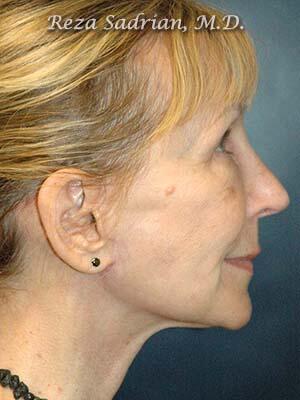 Face & Neck Lift Before & After Image