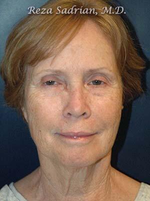 Face & Neck Lift Before & After Image