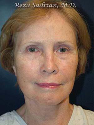 Face & Neck Lift Before & After Image