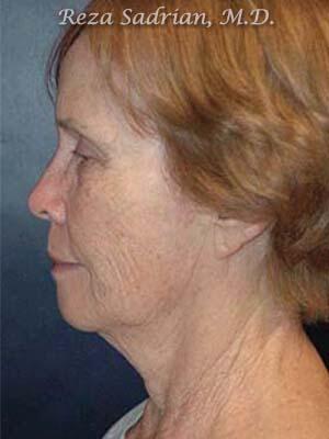 Face & Neck Lift Before & After Image