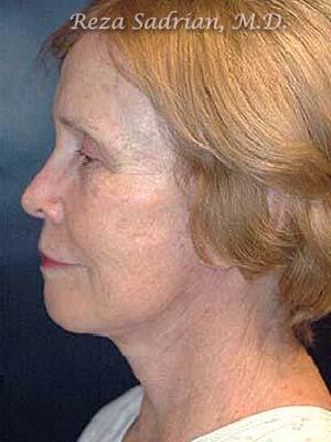 Face & Neck Lift Before & After Image