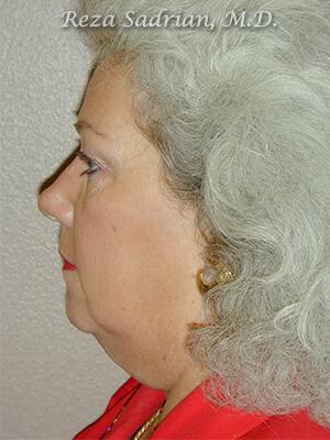 Face & Neck Lift Before & After Image