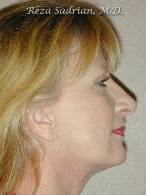 Face & Neck Lift Before & After Image