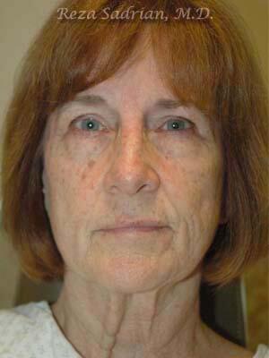 Face & Neck Lift Before & After Image