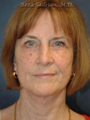 Face & Neck Lift Before & After Image