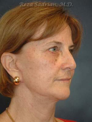 Face & Neck Lift Before & After Image