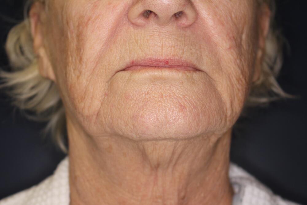 Face & Neck Lift Before & After Image