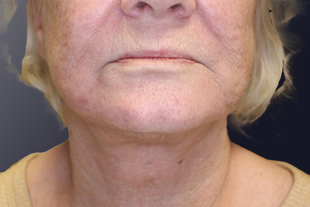 Face & Neck Lift Before & After Image