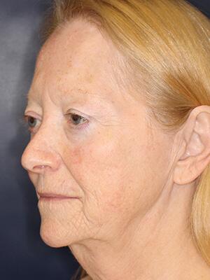 Face & Neck Lift Before & After Image