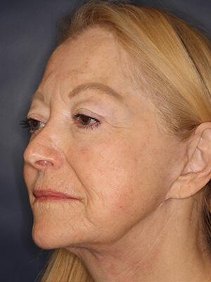 Face & Neck Lift Before & After Image