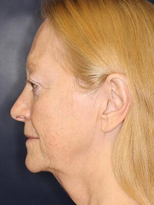 Face & Neck Lift Before & After Image