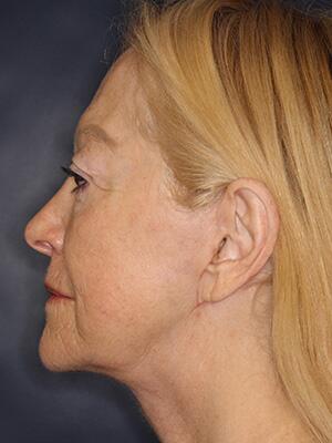 Face & Neck Lift Before & After Image