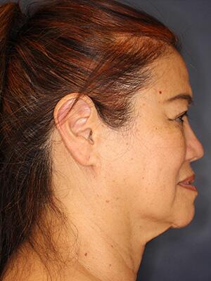 Face & Neck Lift Before & After Image