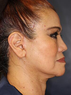 Face & Neck Lift Before & After Image