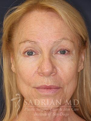 Face & Neck Lift Before & After Image