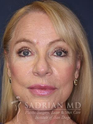 Face & Neck Lift Before & After Image