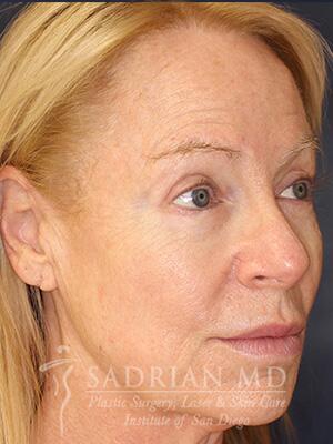 Face & Neck Lift Before & After Image