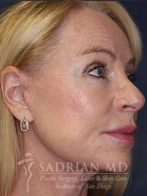 Face & Neck Lift Before & After Image