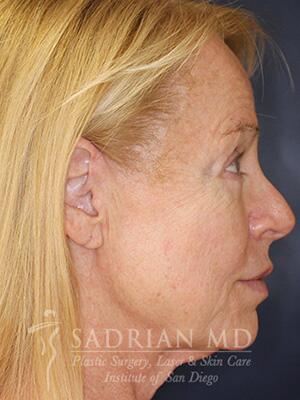 Face & Neck Lift Before & After Image