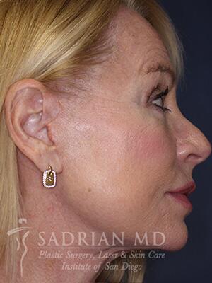 Face & Neck Lift Before & After Image