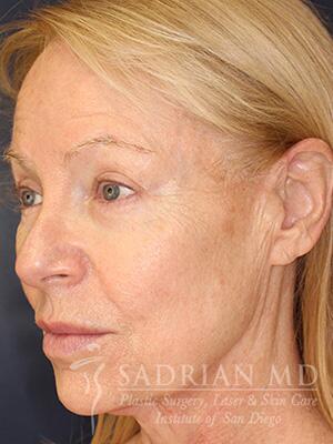 Face & Neck Lift Before & After Image